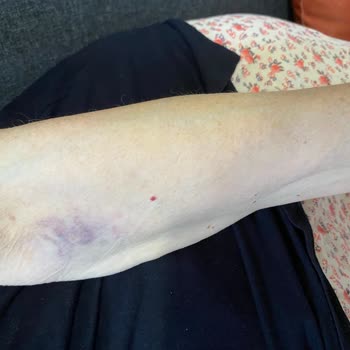 80 Yaşındaki Annenin Ambulans Tarafından Alınmaması Ve Hastanedeki Kötü Muamele
