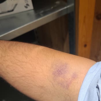 Kan Alımında Şiddetli Morluk Ve Uzun Bekleme Süresi