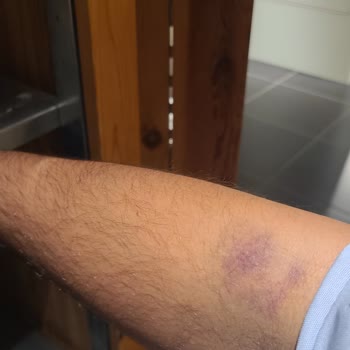 Kan Alımında Şiddetli Morluk Ve Uzun Bekleme Süresi