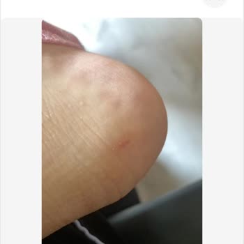 Garanti Kapsamındaki Sneaker’da Metal Parça Çıkması Ve İade Reddi