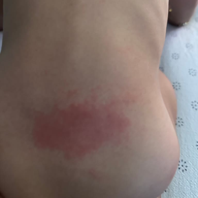 Prima Pampers Aktif Bebek Bezi Nedeniyle Bebekte Şiddetli Pişik Ve İade Talebi