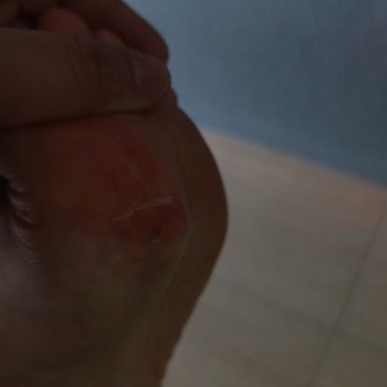 Deichmann Sandaletinde Kısa Sürede Su Birikmesi Ve Yara Açması