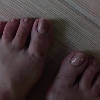 Deichmann Sandaletinde Kısa Sürede Su Birikmesi Ve Yara Açması