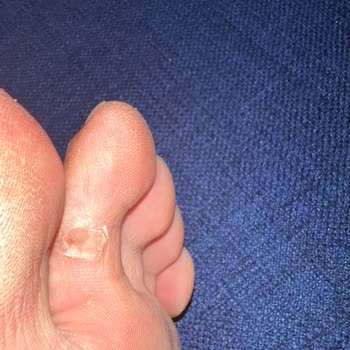 Birkenstock Gizeh Eva Terliği Ayağımda Yara Ve Ağrı Yaratıyor, İade Talebi