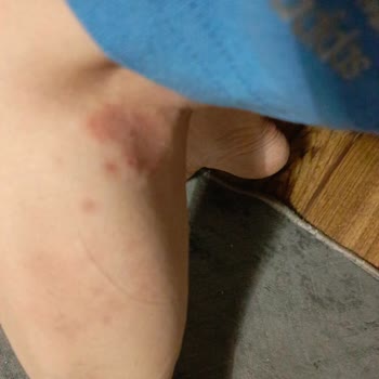 Dexpadu Tabletinin Şiddetli Cilt Reaksiyonları Ve Mide Bulantısı