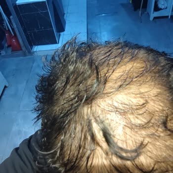 Saç Kökü Zedelenmesiyle Sonuçlanmayan PRP Ve Eksozom Tedavisi