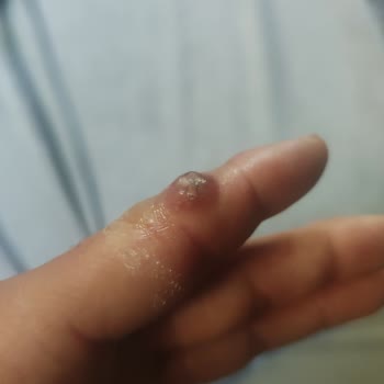Acil Serviste Basit Kıymık Çıkarma İşlemi Yapılamaması