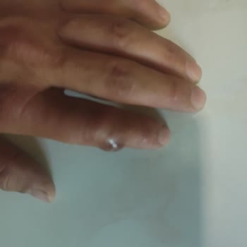 Acil Serviste Basit Kıymık Çıkarma İşlemi Yapılamaması