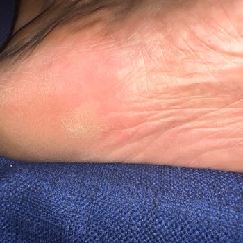 Heridas entre los dedos por Birkenstock Gizeh, solicito reembolso