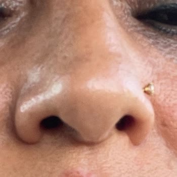 Tekrarlanan Burun Estetiği Ameliyatları Ve Nefes Sorunları İçin Maddi Manevi Tazminat Talebi