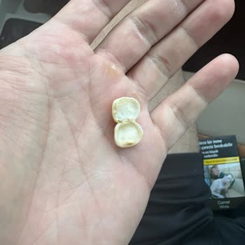 Alfa Dental'in Sözünü Tutmaması Ve Hatalı Tedavileri Sonucu Diş Mağduriyeti