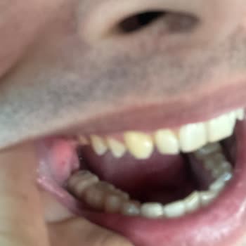 Alfa Dental'in Sözünü Tutmaması Ve Hatalı Tedavileri Sonucu Diş Mağduriyeti