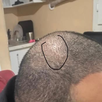 Clinic Expert Saç Ekimi Asimetrisi: Garantili Ücretsiz Düzeltme Ve İade Talebi