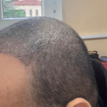 Clinic Expert Saç Ekimi Asimetrisi: Garantili Ücretsiz Düzeltme Ve İade Talebi
