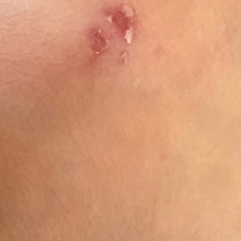 Tahta Kuruları Nedeniyle Tatilde Sağlık Felaketi