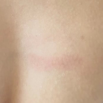 Tahta Kuruları Nedeniyle Tatilde Sağlık Felaketi