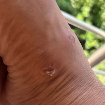 Ayağımda Yaralar Açan Hotiç Terliği İçin Koşulsuz İade Talebi