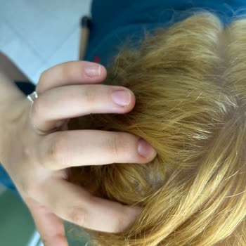 Schwarzkopf Saç Boyasında Yanma, Yara Ve Renk Uyuşmazlığı