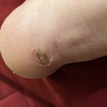 Ayakkabının Topuk Bölümü Ayağımı Yara Açtı, İade Reddedildi Ve Ürün İmha Edilecek