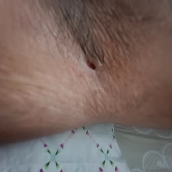 Deodorant Kremi Cildimde Delik Açtı, Şiddetli Ağrı Ve Hareket Kısıtlaması
