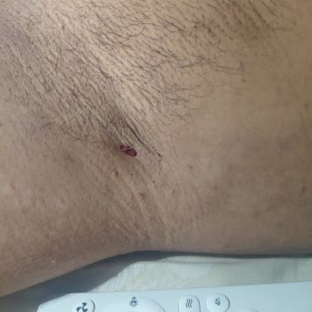 Deodorant Kremi Cildimde Delik Açtı, Şiddetli Ağrı Ve Hareket Kısıtlaması