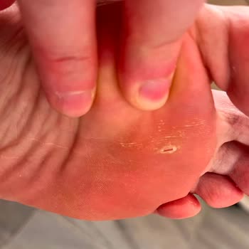 Ayıplı Terlikte Su Birikintisi Ve Yaralı Ayaklar İade Talebi Reddedildi