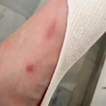 Ayıplı Terlikte Su Birikintisi Ve Yaralı Ayaklar İade Talebi Reddedildi