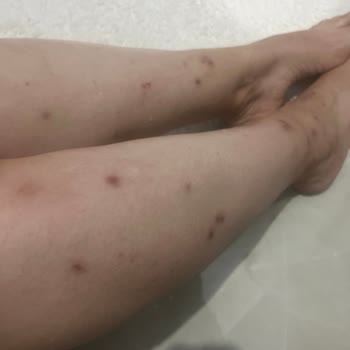 Siveno Sivrisinek Kovucu Hiç Etkili Değildi Ve Bacaklarıma İz Bıraktı