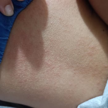 Mustela Bebek Şampuanı Alerjik Cilt Reaksiyonu Ve İade Talebi