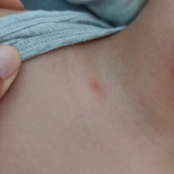 Mustela Bebek Şampuanı Alerjik Cilt Reaksiyonu Ve İade Talebi