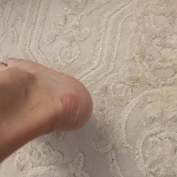 Sağ Ayak Topuğunda Su Toplanması Ve Vurması, Değişim Reddi
