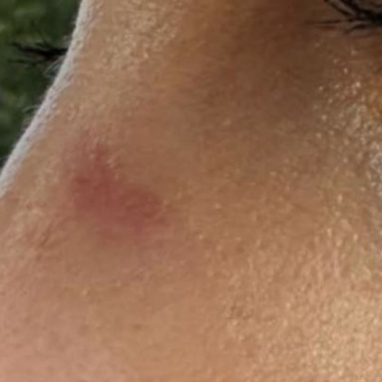 Atasun Optik Wayfarer Gözlüğünün Burun Baskısı Nedeniyle Ayıplı Olması Ve Garanti Reddi