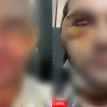 Yüz Germe Sonrası Daha Geniş ve Dolgun Yüz, Kontur Sorunları, Boyun Hareket Kısıtlılığı ve Belirgin İzler