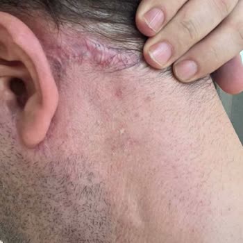 Yüz Germe Sonrası Daha Geniş ve Dolgun Yüz, Kontur Sorunları, Boyun Hareket Kısıtlılığı ve Belirgin İzler