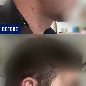 Yüz Germe Sonrası Daha Geniş ve Dolgun Yüz, Kontur Sorunları, Boyun Hareket Kısıtlılığı ve Belirgin İzler