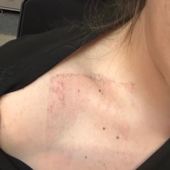 Holter Cihazı Çıkarılırken Bantların Sert Çekilmesi Nedeniyle Cilt Tahrişi