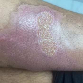 Karaca Termos Patlaması Ve Yanık: Mağaza İlgisizliği