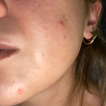 La Roche-Posay Güneş Kremi Atopik Ciltte Şiddetli Sivilcelenme Ve Sarımsak Kokusu Yarattı