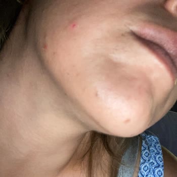 La Roche-Posay Güneş Kremi Atopik Ciltte Şiddetli Sivilcelenme Ve Sarımsak Kokusu Yarattı