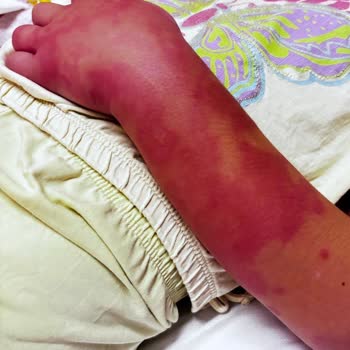 İhmalci Muayene Ve Yanlış Urtiker Tanısı Çocuğumuzun Sağlığını Tehdit Etti