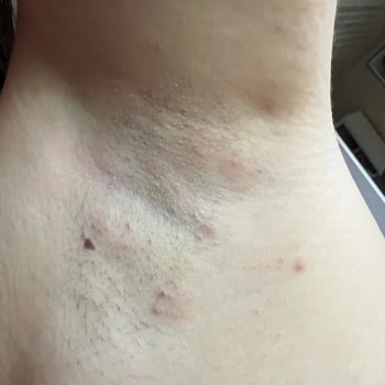 Deotak Mor Krem Kullanımı Sonrası Ağrılı Şişlik Ve Bezeler