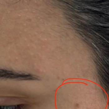 Neu Güzellik Bağcılar’da İşlem Sonrası Leke Ve Hakaret İçeren Personel Tutumu