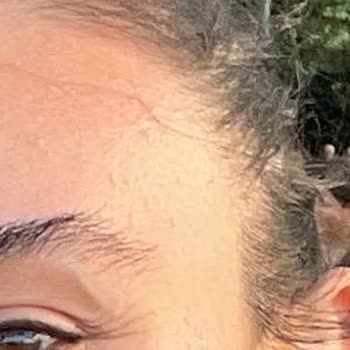 Neu Güzellik Bağcılar’da İşlem Sonrası Leke Ve Hakaret İçeren Personel Tutumu