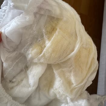 Molfix Bezinde Şeffaf Tanecikler Ve Şiddetli Pişik