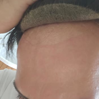Premium Saç Protezlerinde Sürekli Dökülme Ve Cilt Tahrişi, Onarımda Çözüm Yok, İade Talebi