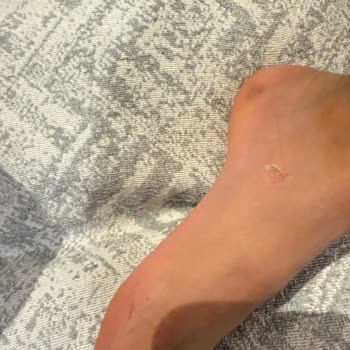 Çocuk Kramponundaki Ciddi Yara Ve Boyner'in İade Reddi