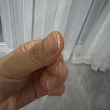 Kısa Temasta Cilt Yanması Ve Tahrişi Neden Oldu Asperox Pembe Güç Leke Çıkarıcı