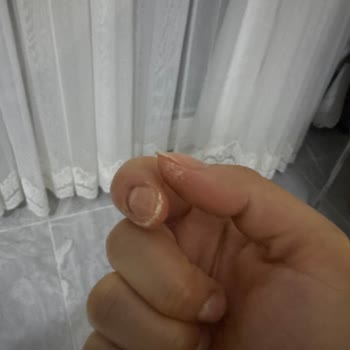 Kısa Temasta Cilt Yanması Ve Tahrişi Neden Oldu Asperox Pembe Güç Leke Çıkarıcı
