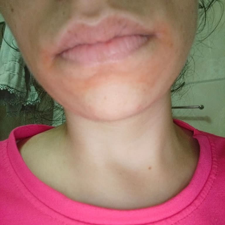 Trendyol'dan Aldığım La Roche Posay Ürünü Ciltte Yanma Ve Leke Bıraktı İade Talep Ediyorum