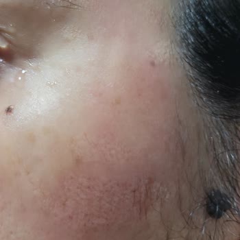 Sebamed Şampuanı Alerjik Reaksiyon Yaratırken Watsons İade Talebini Reddetti